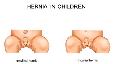 Hernias in Children