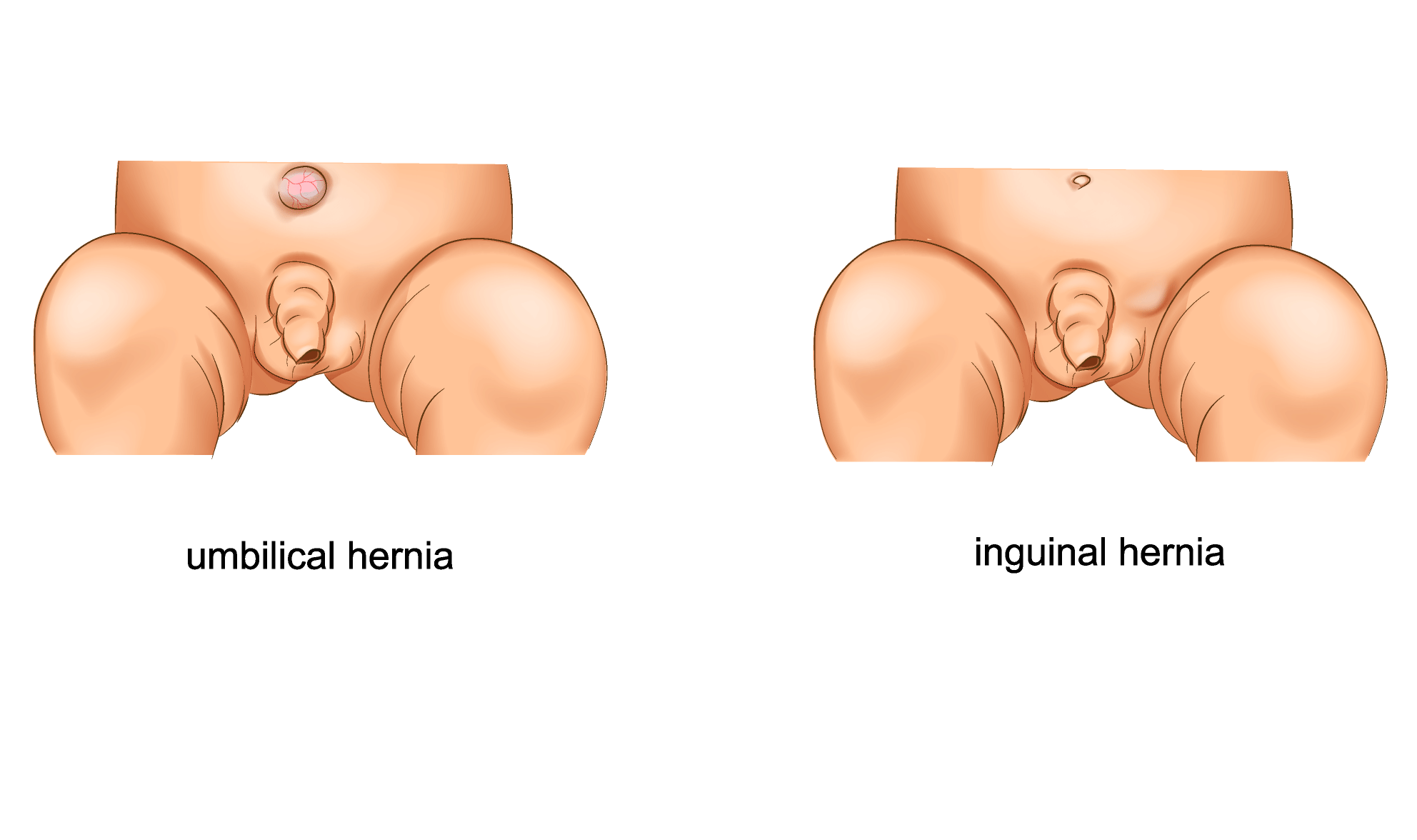 Umbilical Hernia in Newborn  How to manage umbilical hernia in