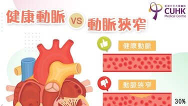 健康動脈 VS 動脈狹窄